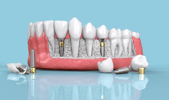 DENTAL IMPLANTS 02