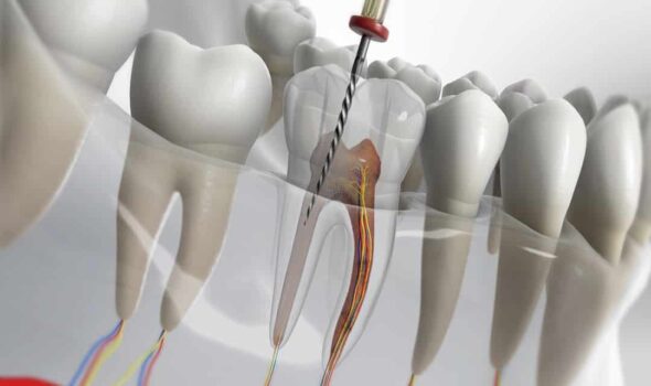ROOT CANAL01
