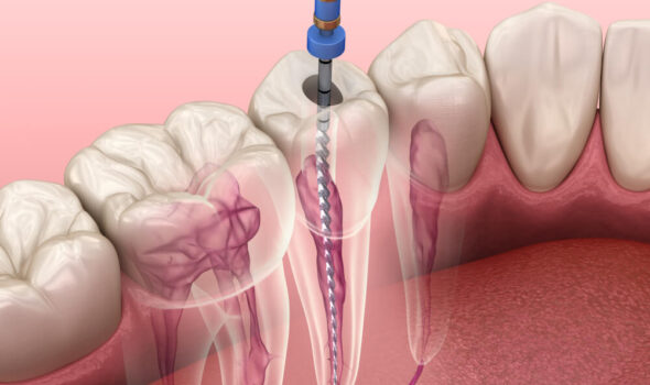 Root-Canal-Treatment-1